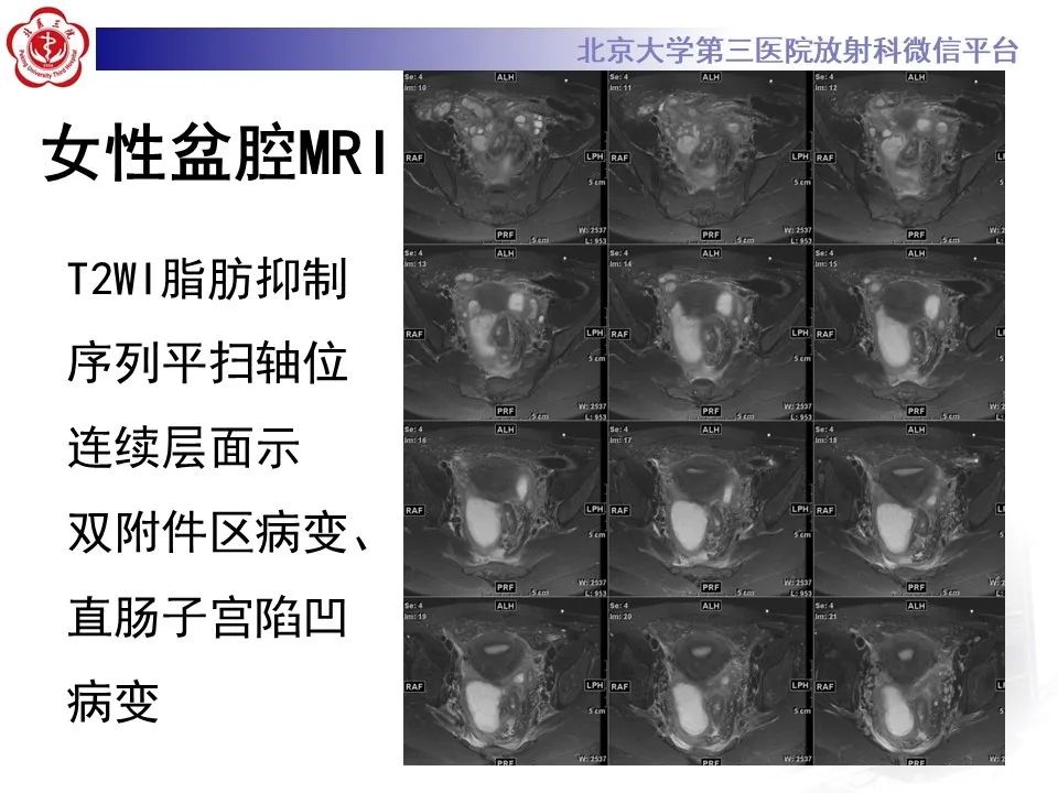【病例】盆腔炎1例MR影像