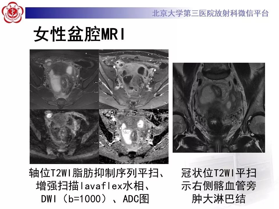 【病例】盆腔炎1例MR影像