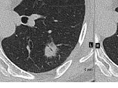 原发性肺黏液腺癌CT表现、病理基础