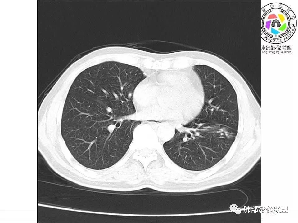 【病例】警惕结核背景下的腺癌