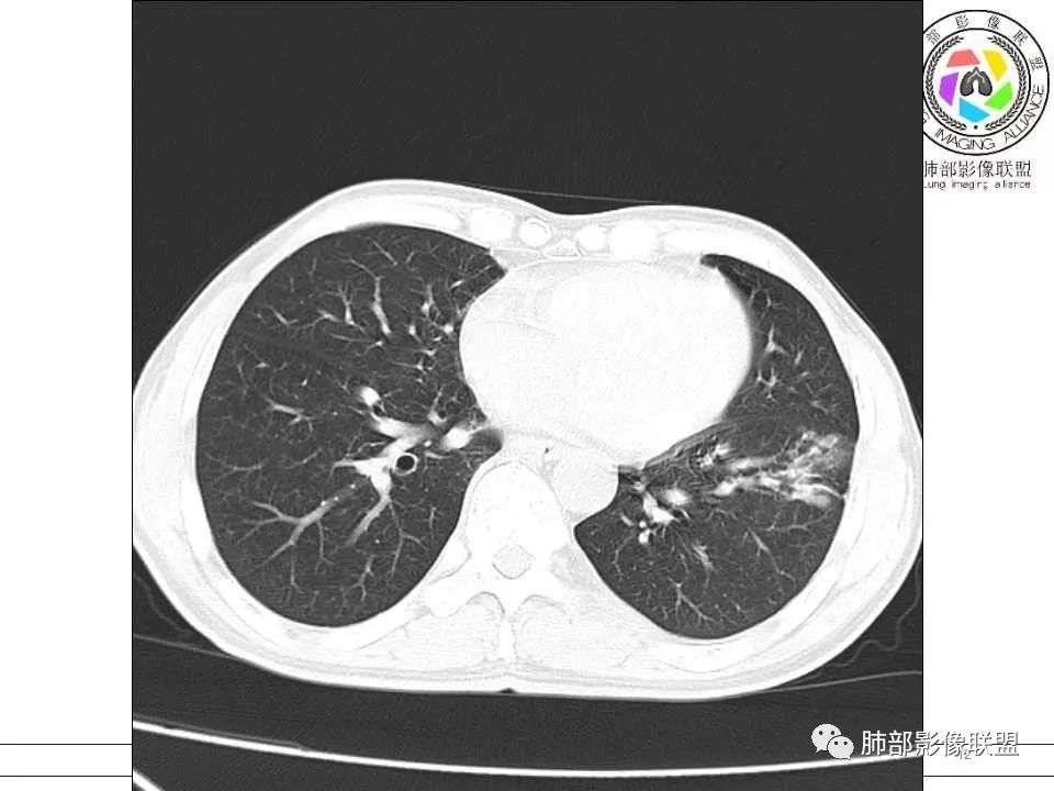 【病例】警惕结核背景下的腺癌