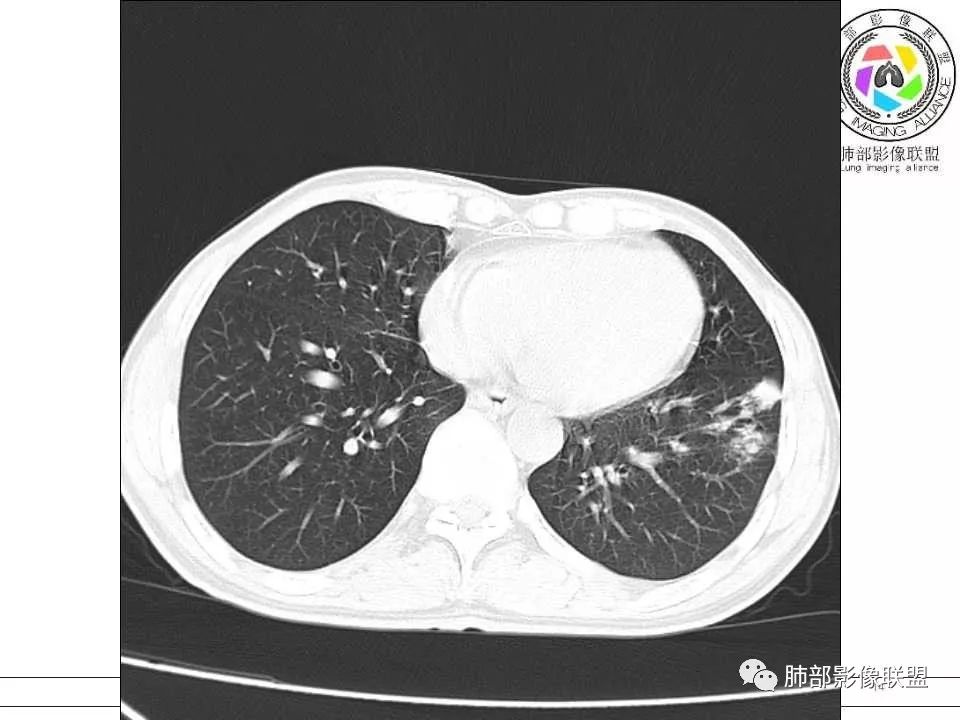 【病例】警惕结核背景下的腺癌