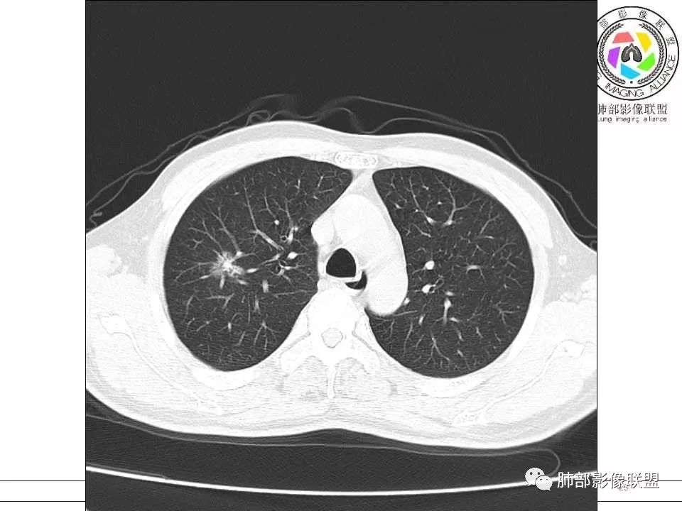 【病例】警惕结核背景下的腺癌