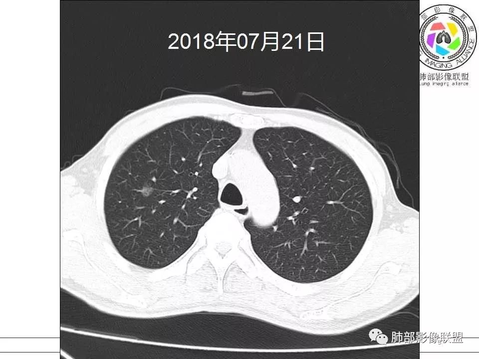 【病例】警惕结核背景下的腺癌