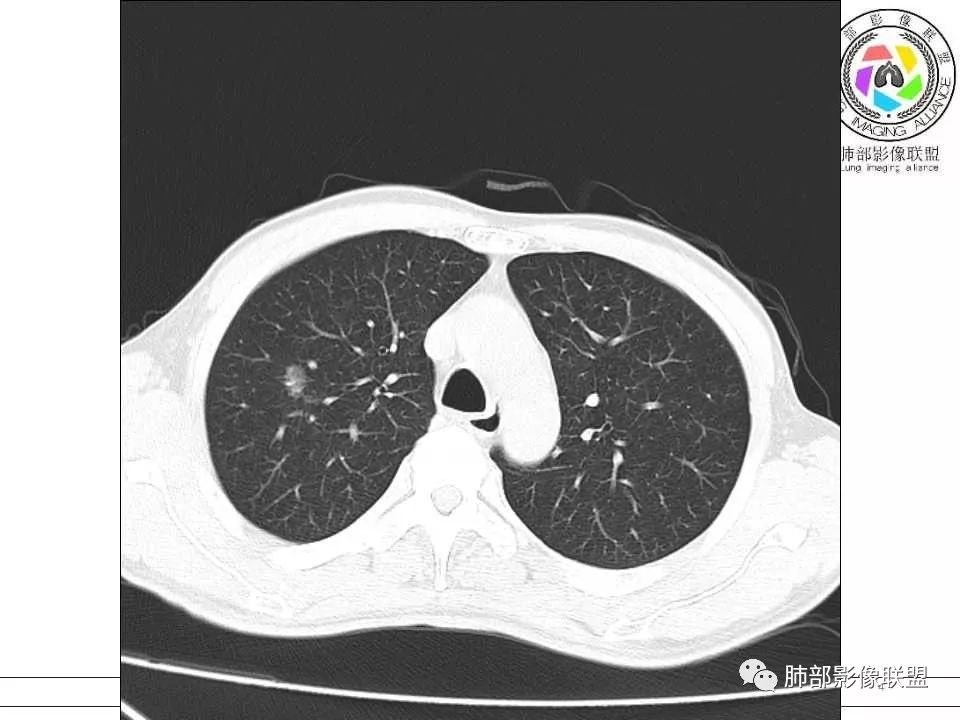 【病例】警惕结核背景下的腺癌