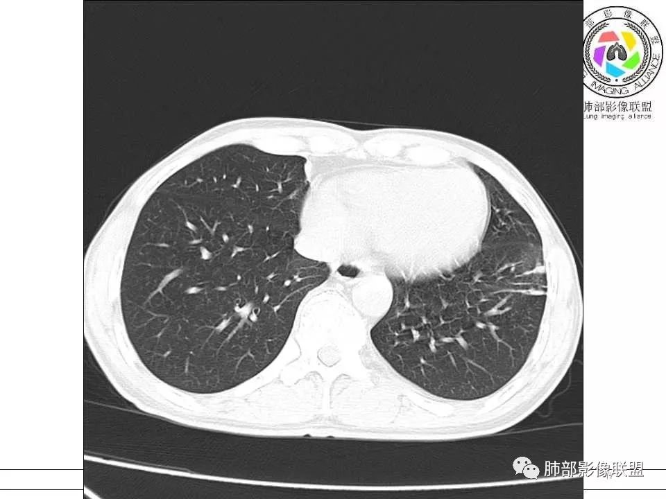 【病例】警惕结核背景下的腺癌