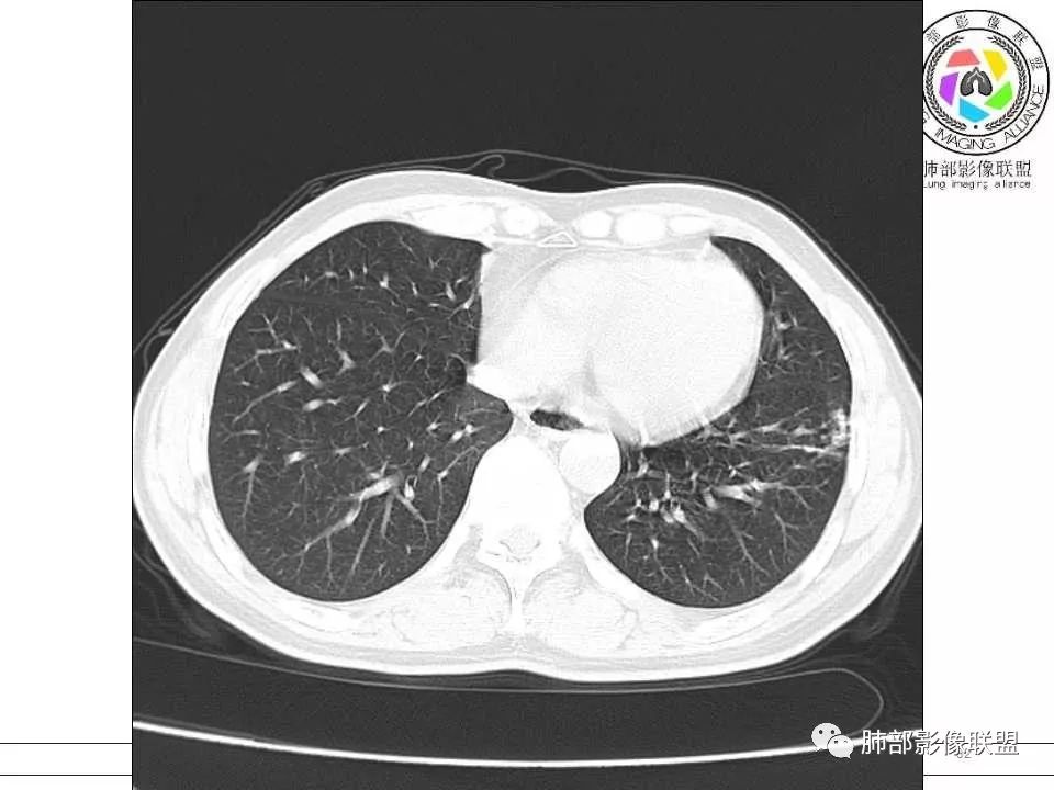 【病例】警惕结核背景下的腺癌