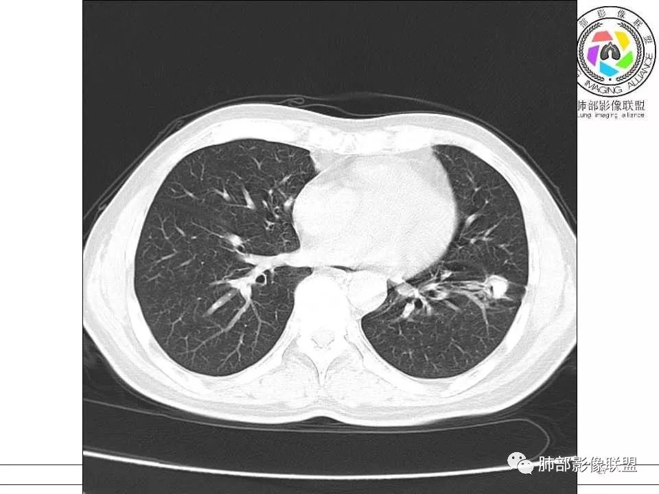 【病例】警惕结核背景下的腺癌