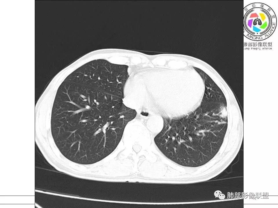 【病例】警惕结核背景下的腺癌