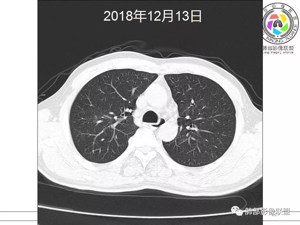 【病例】警惕结核背景下的腺癌