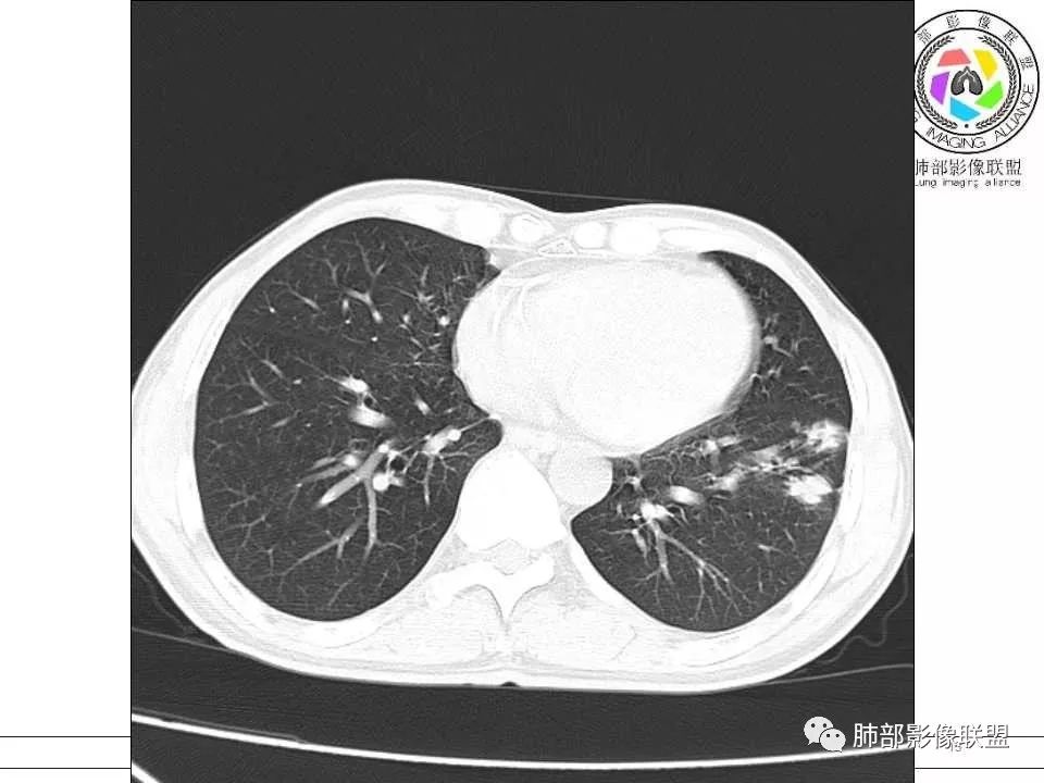 【病例】警惕结核背景下的腺癌