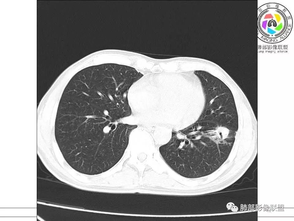 【病例】警惕结核背景下的腺癌