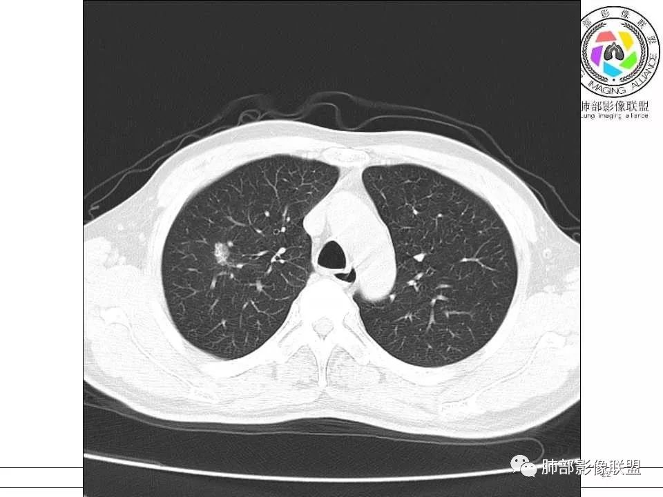 【病例】警惕结核背景下的腺癌