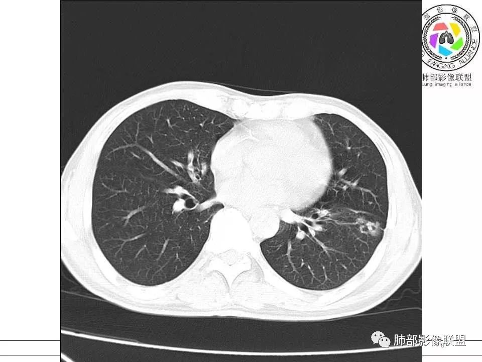 【病例】警惕结核背景下的腺癌