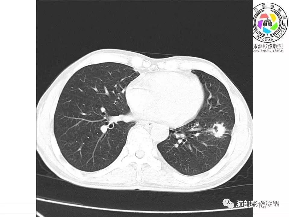 【病例】警惕结核背景下的腺癌