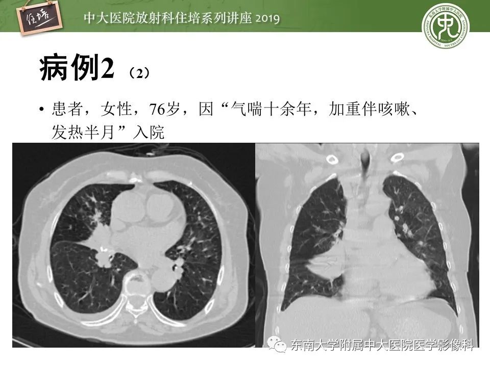 【PPT】呼吸系统急症影像解读