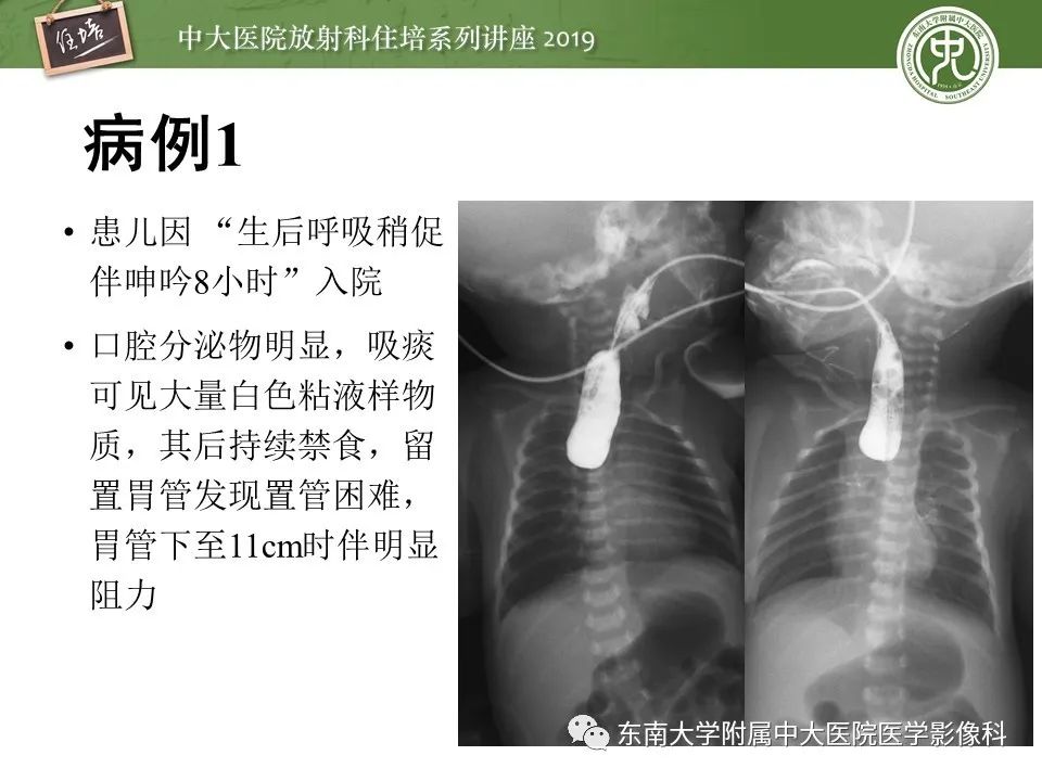 【PPT】呼吸系统急症影像解读