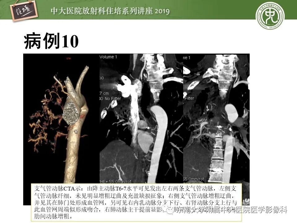 【PPT】呼吸系统急症影像解读