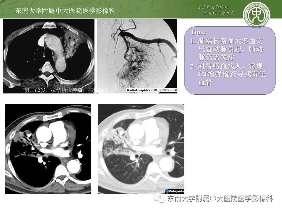 【PPT】呼吸系统急症影像解读
