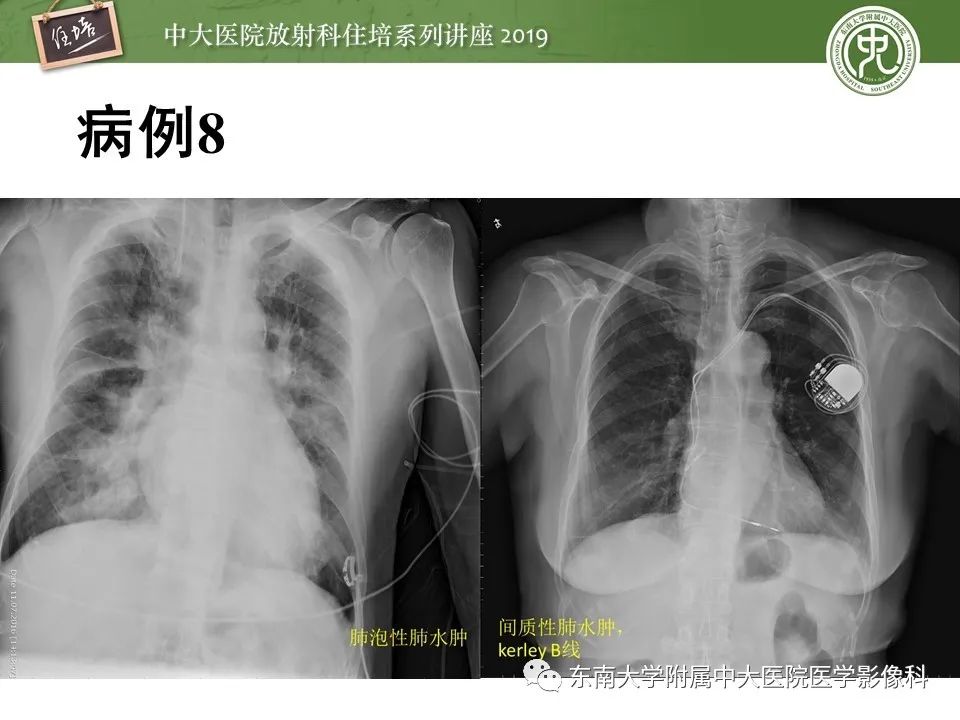 【PPT】呼吸系统急症影像解读