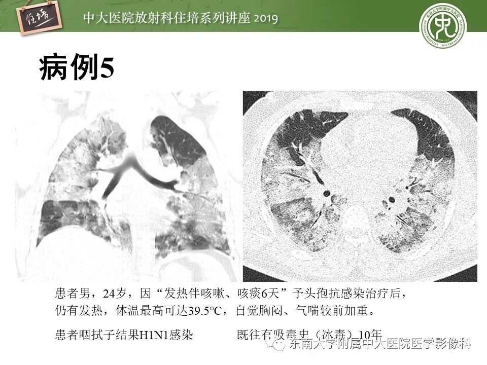 【PPT】呼吸系统急症影像解读