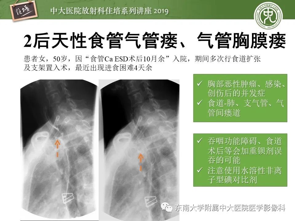 【PPT】呼吸系统急症影像解读