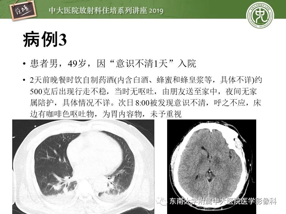 【PPT】呼吸系统急症影像解读