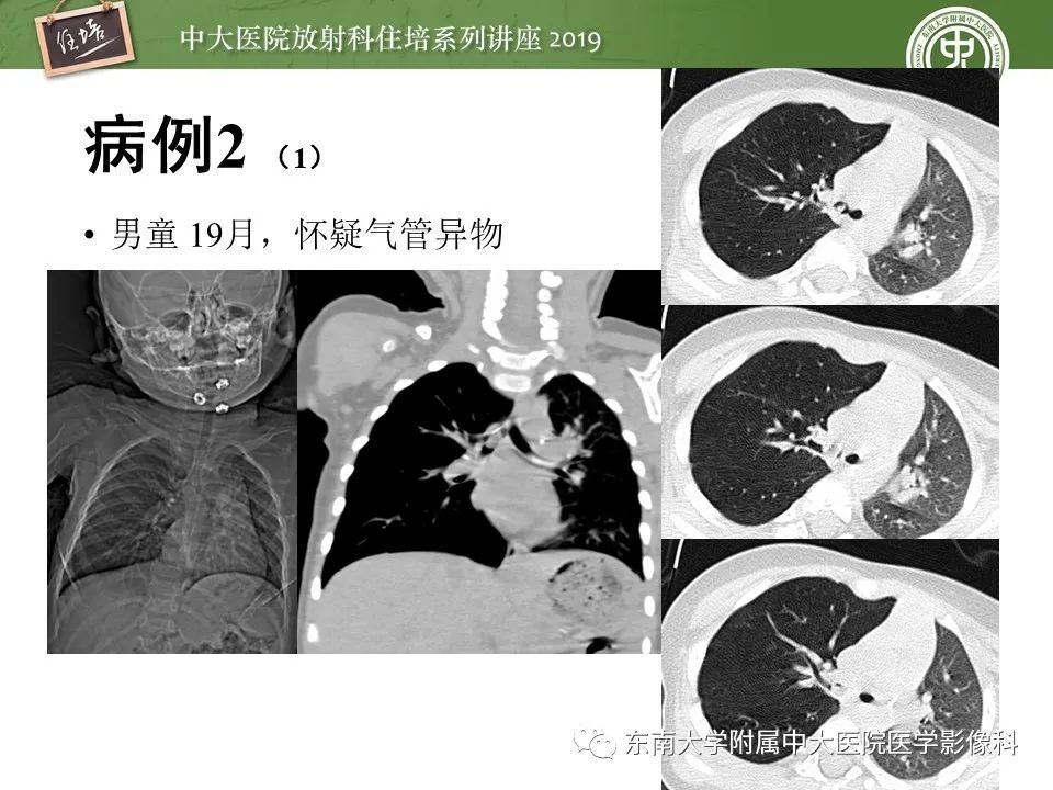 【PPT】呼吸系统急症影像解读