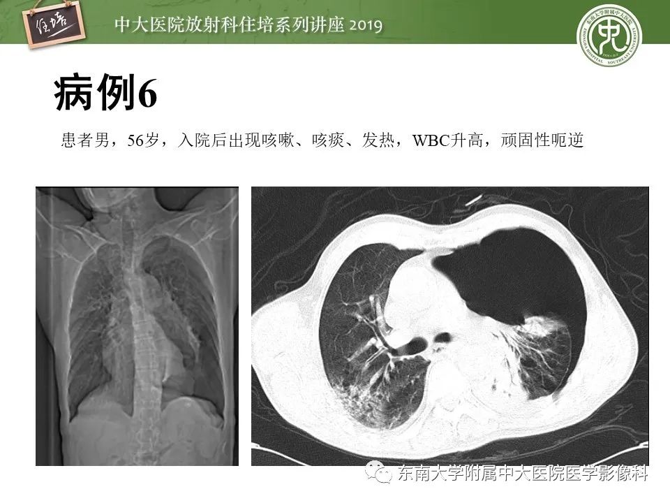 【PPT】呼吸系统急症影像解读