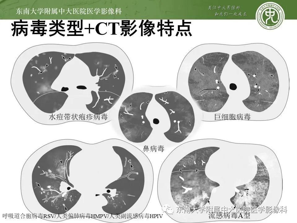 【PPT】呼吸系统急症影像解读