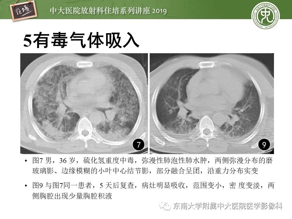 【PPT】呼吸系统急症影像解读