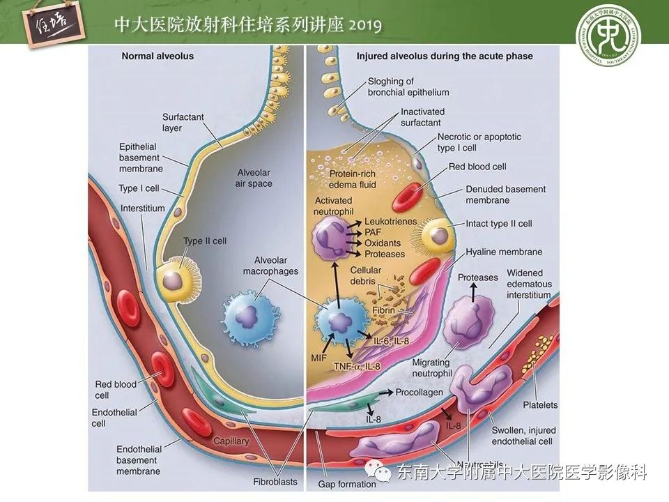 【PPT】呼吸系统急症影像解读
