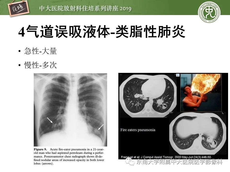 【PPT】呼吸系统急症影像解读
