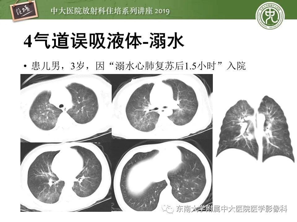 【PPT】呼吸系统急症影像解读