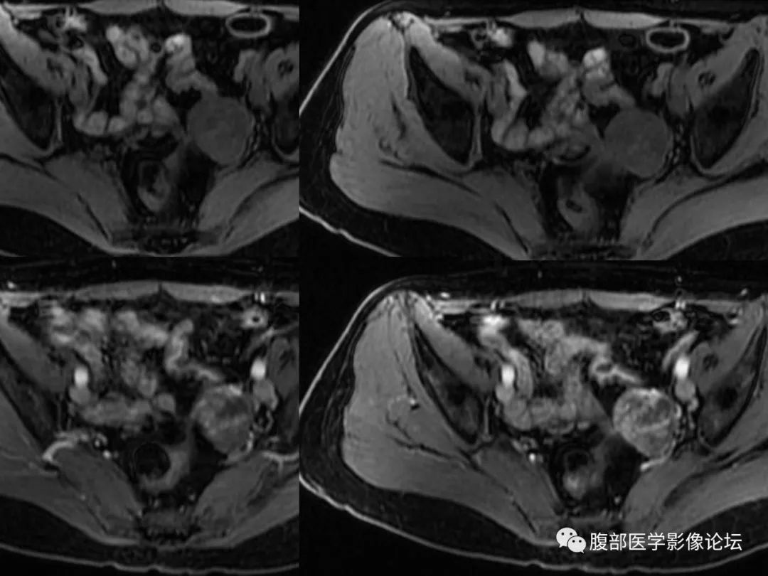 【病例】卵巢透明细胞癌1例MR影像