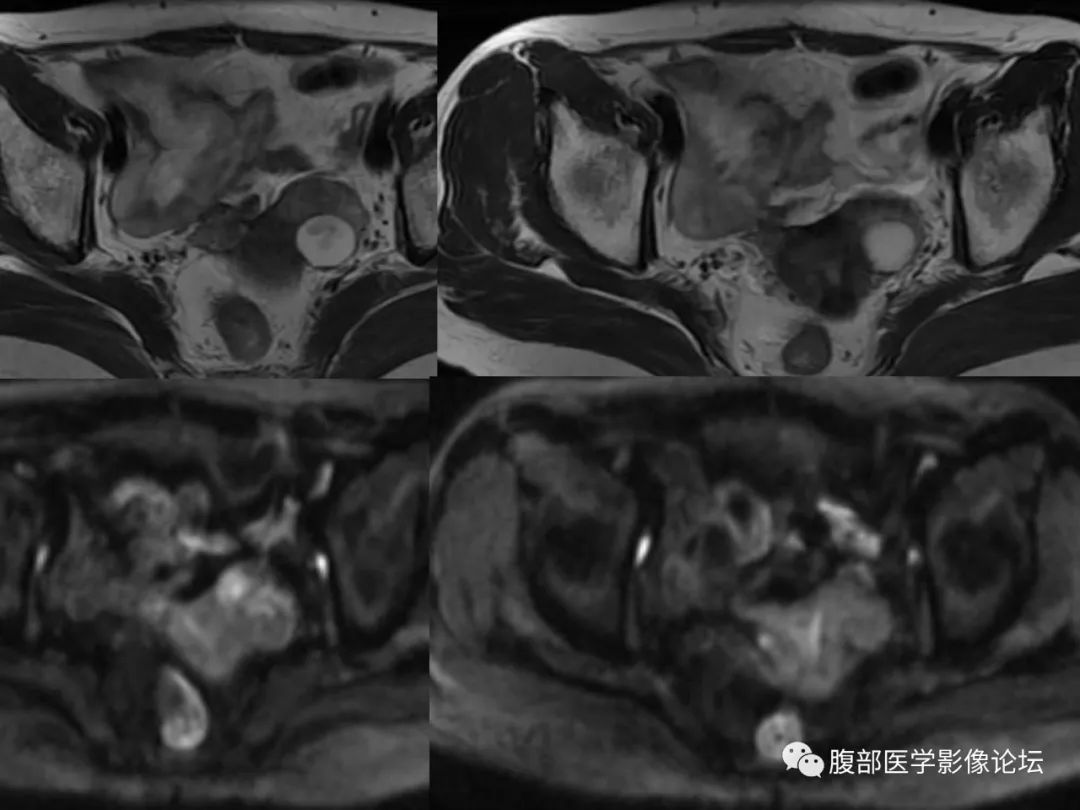 【病例】卵巢透明细胞癌1例MR影像