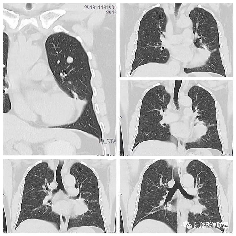【病例】诡异的左肺包块