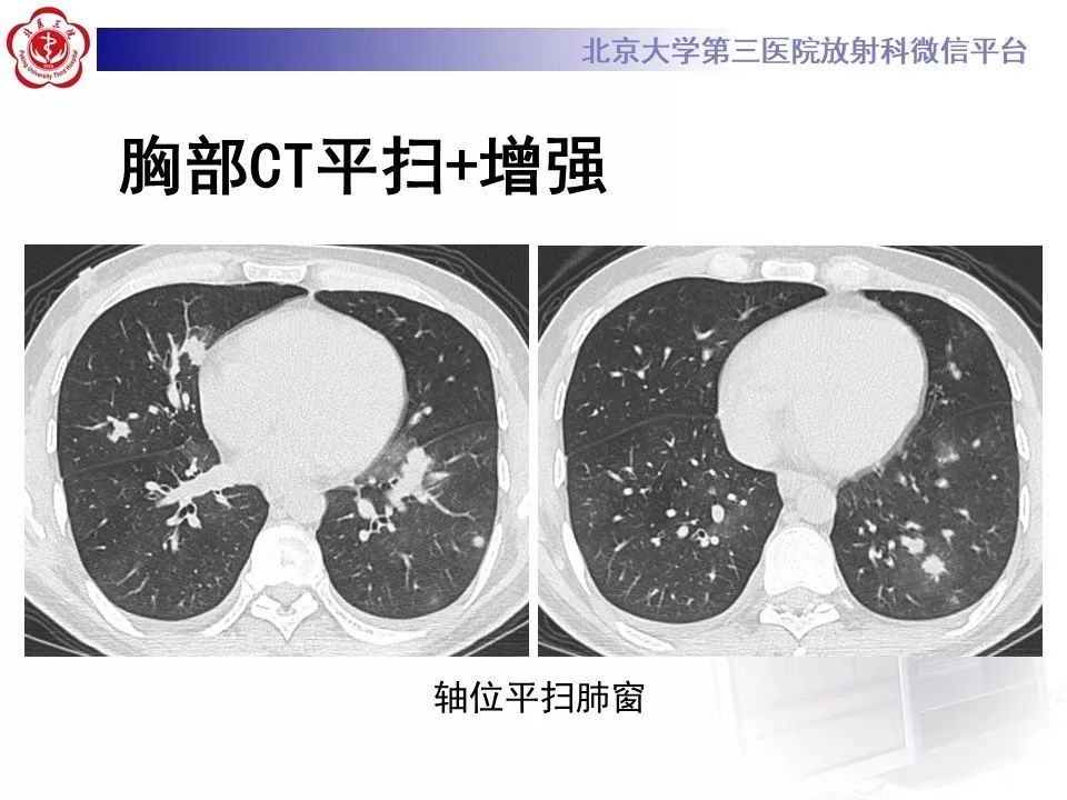 【病例】原发性肺淋巴瘤1例CT影像