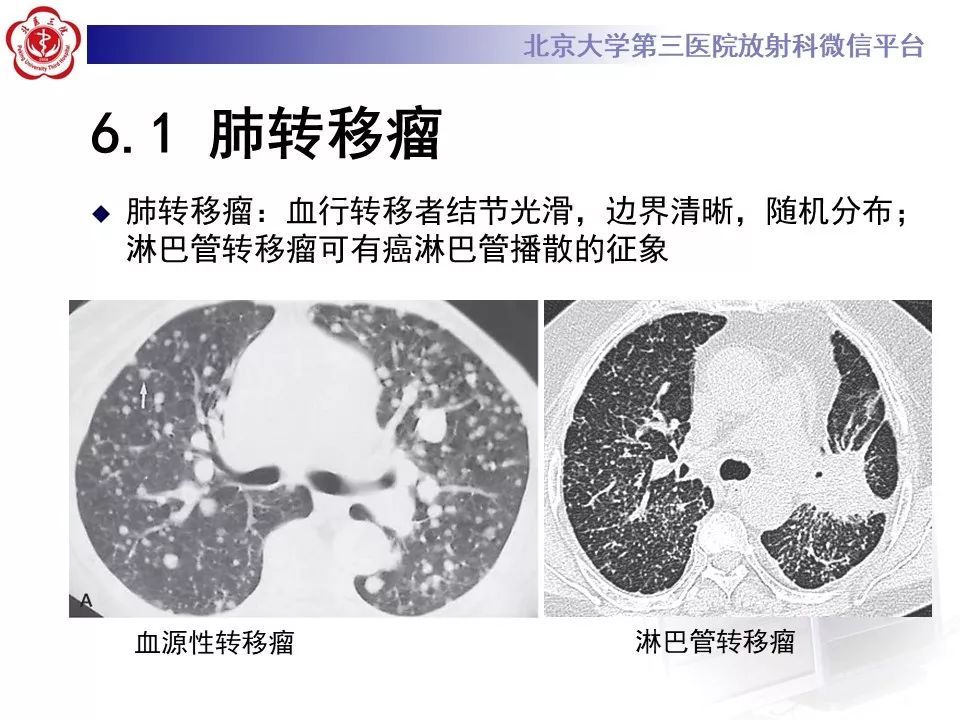 【病例】原发性肺淋巴瘤1例CT影像