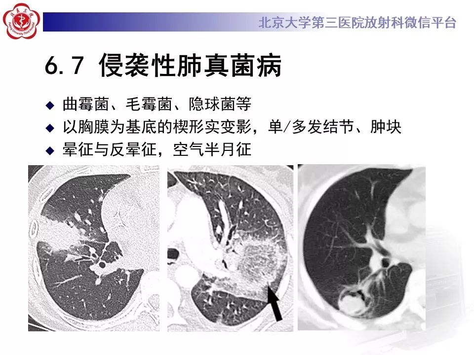 【病例】原发性肺淋巴瘤1例CT影像