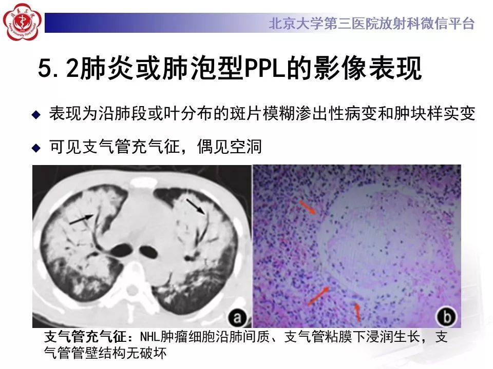 【病例】原发性肺淋巴瘤1例CT影像