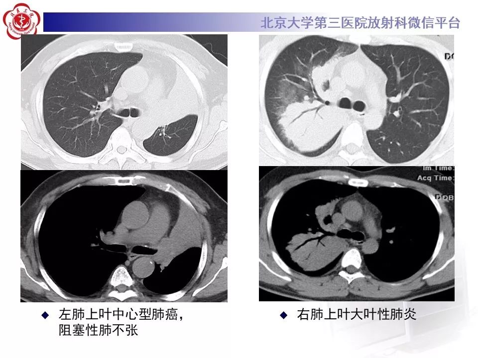 【病例】原发性肺淋巴瘤1例CT影像