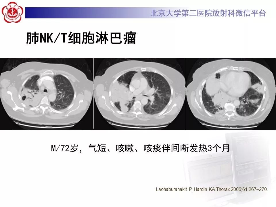 【病例】原发性肺淋巴瘤1例CT影像