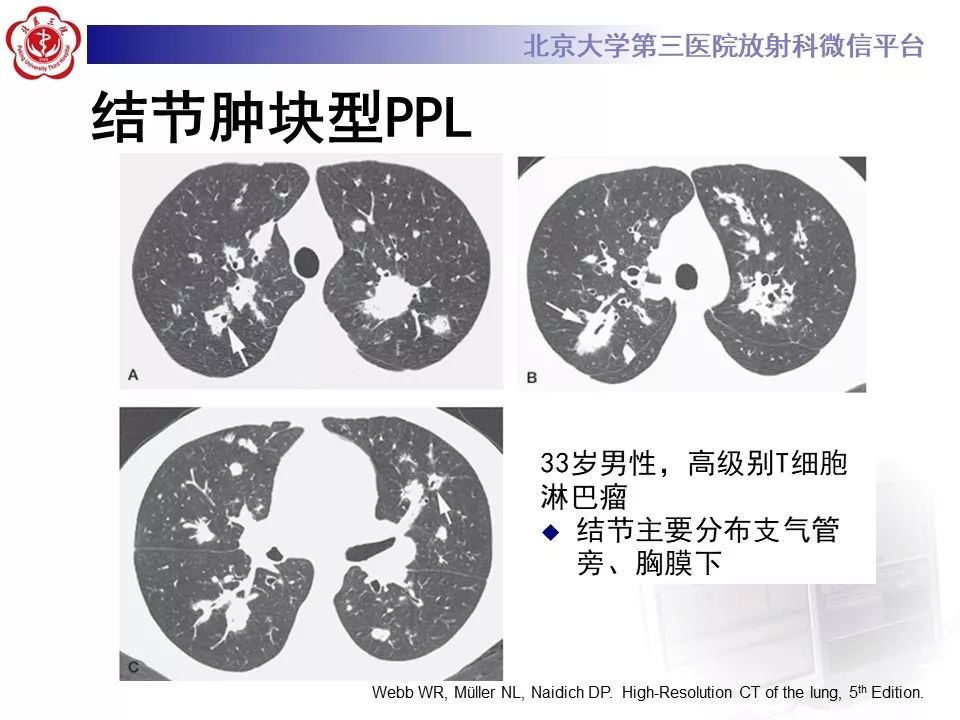 【病例】原发性肺淋巴瘤1例CT影像