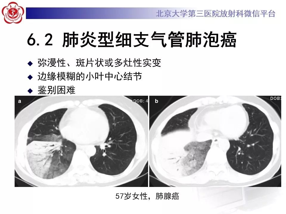 【病例】原发性肺淋巴瘤1例CT影像