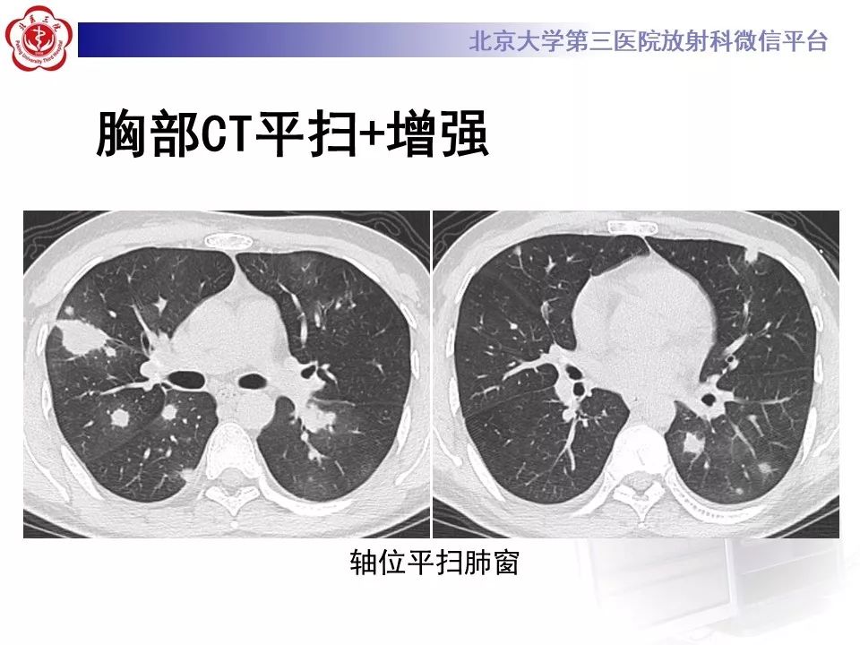 【病例】原发性肺淋巴瘤1例CT影像