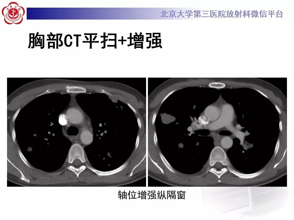 【病例】原发性肺淋巴瘤1例CT影像