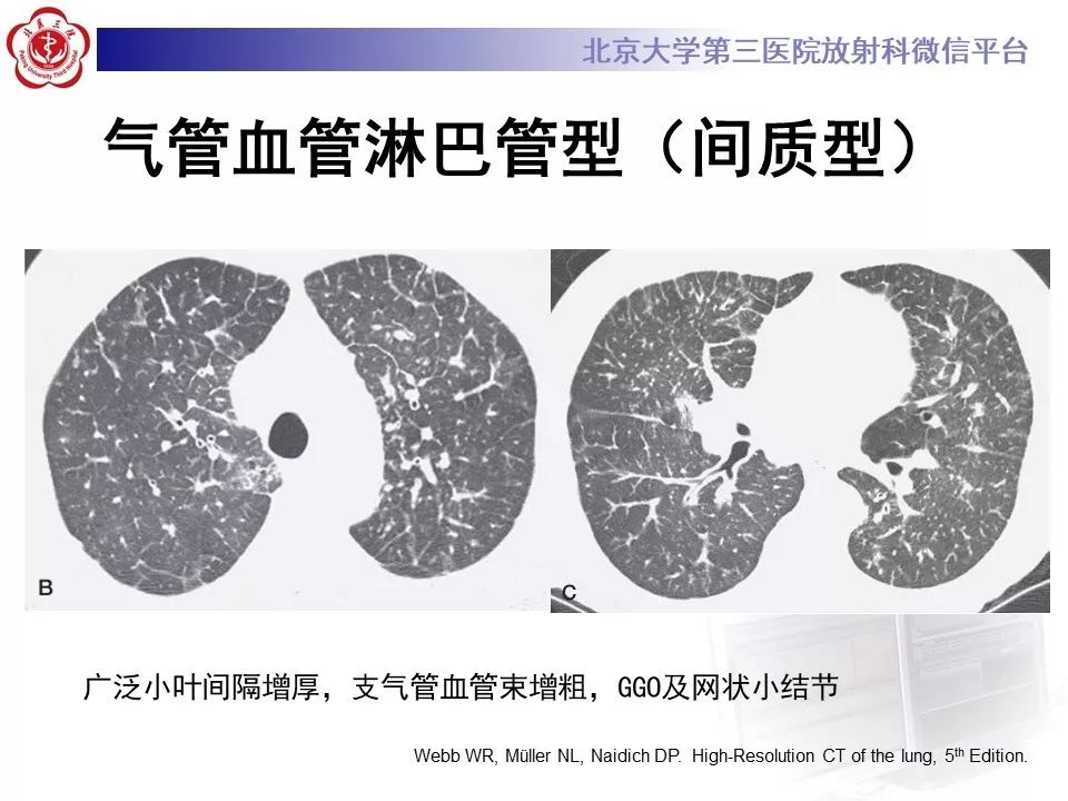 【病例】原发性肺淋巴瘤1例CT影像