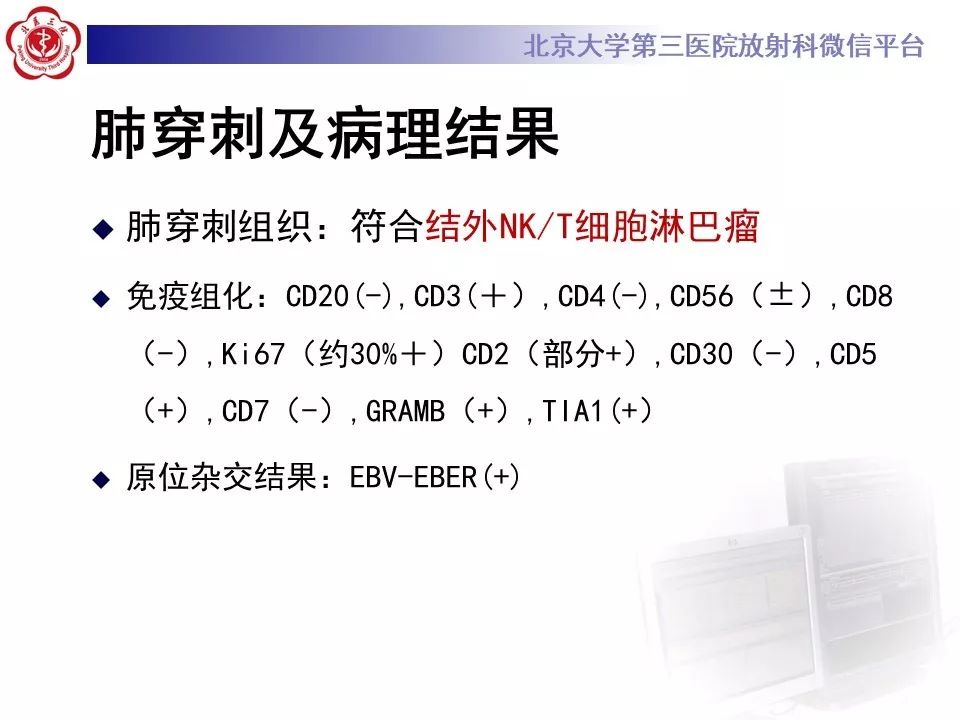 【病例】原发性肺淋巴瘤1例CT影像