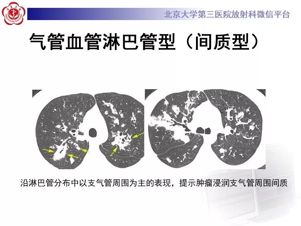 【病例】原发性肺淋巴瘤1例CT影像